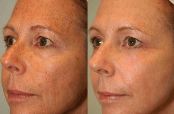 girl face showing improvement of Inno exfo peel treatment benefits