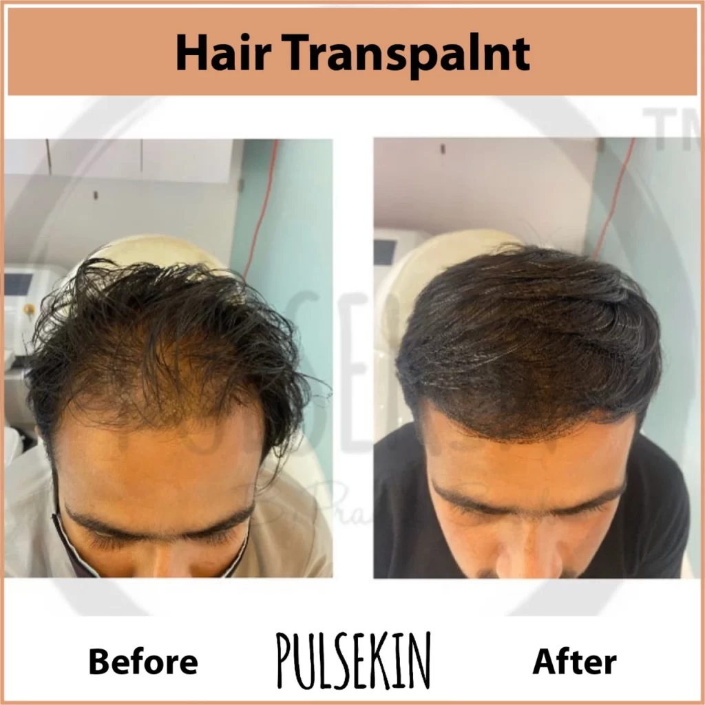 Hair Transplant at Treatment at Pulsekin Clinic Jaipur
