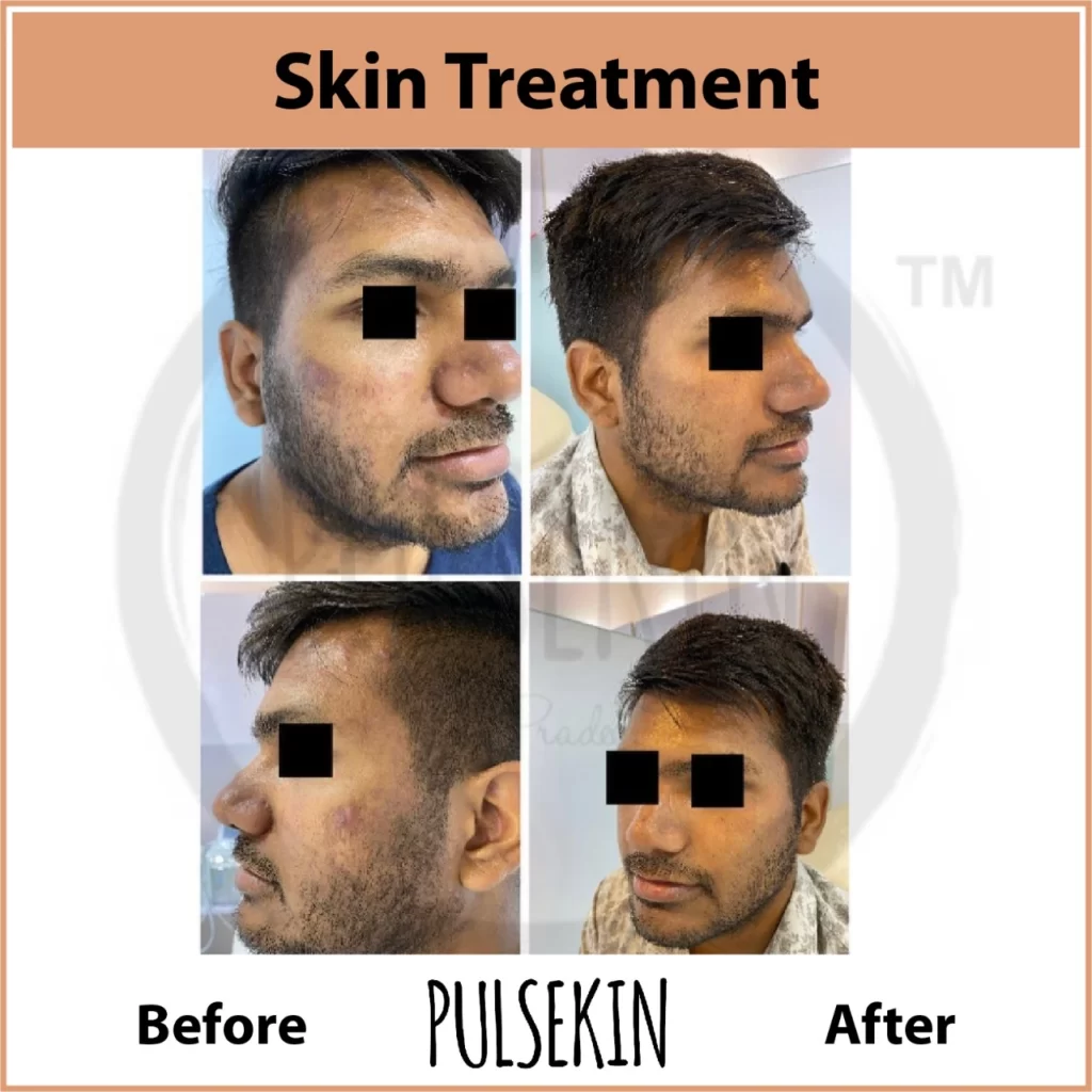 Skin Problem Solution at Pulsekin Clinic Jaipur