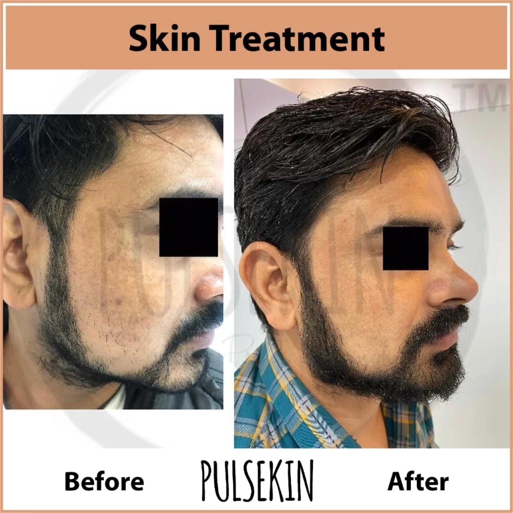 acne Treatment at Pulsekin Clinic Jaipur