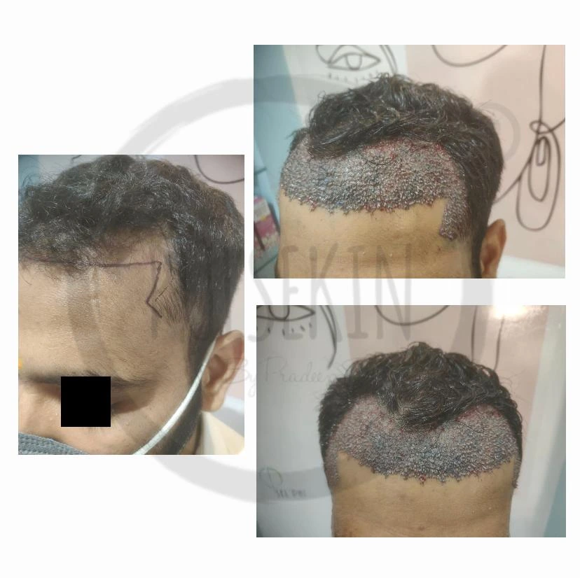 baldness Treatment at Pulsekin Clinic Jaipur