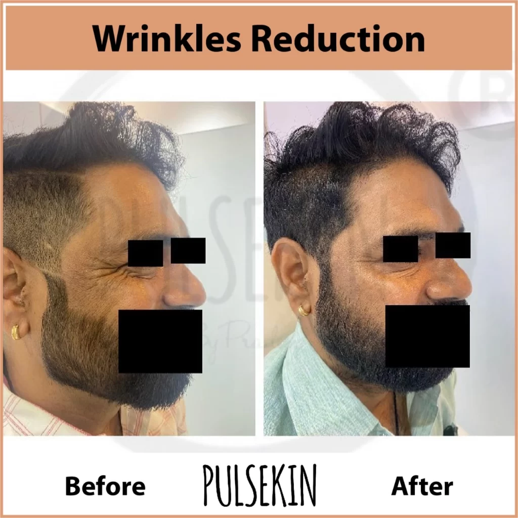 wrinklefine lines Treatment at Pulsekin Clinic Jaipur