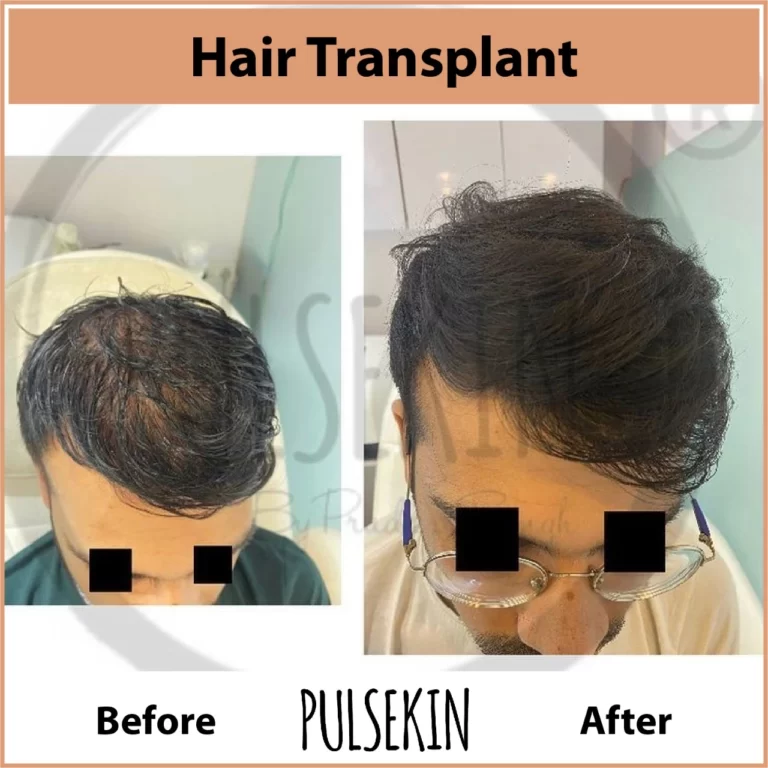 Hair Transplant Hair Transplant at Pulsekin Clinic Jaipur