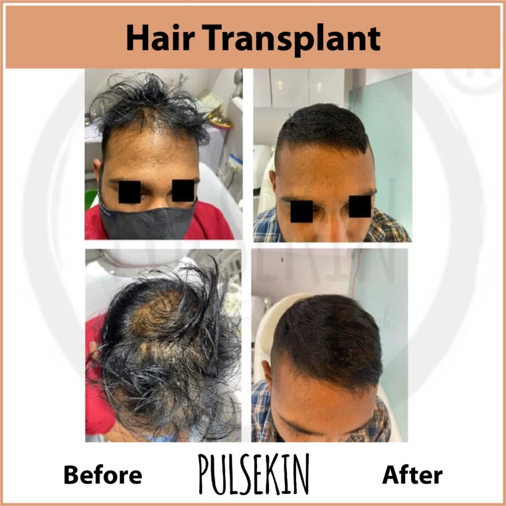 Hairline transplant at Pulsekin Clinic Jaipur