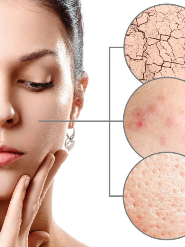 How to treat Acne, Pimples