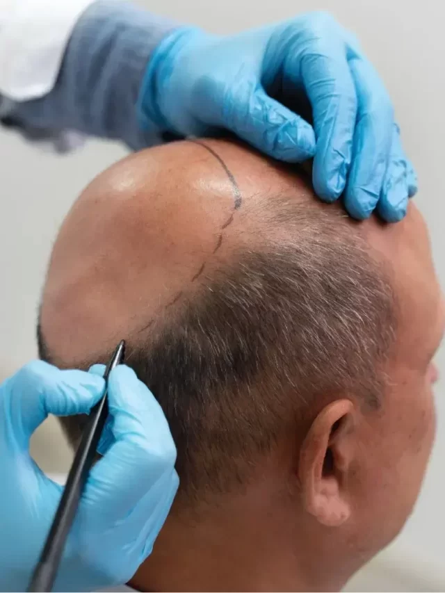Hair Transplant Procedure: FUE & FUT