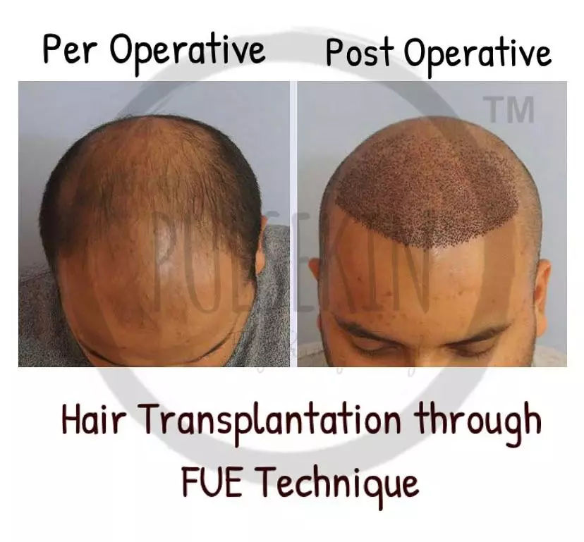 hair transplant by FUE technique at pulsekin jaipur