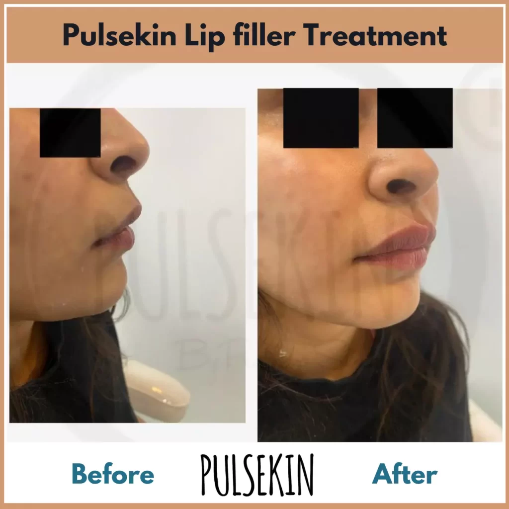Lip filler before and after Pulsekin