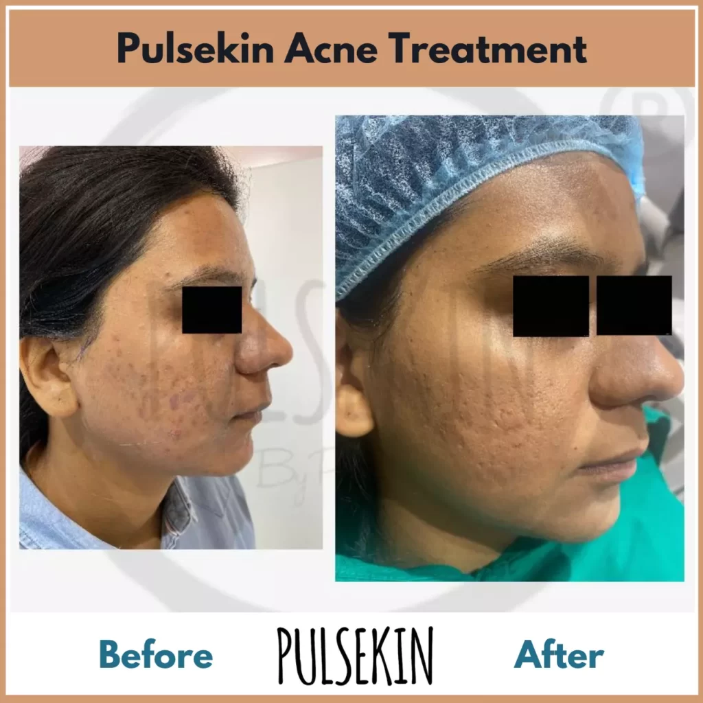 Pulsekin Acne Treatment Before After