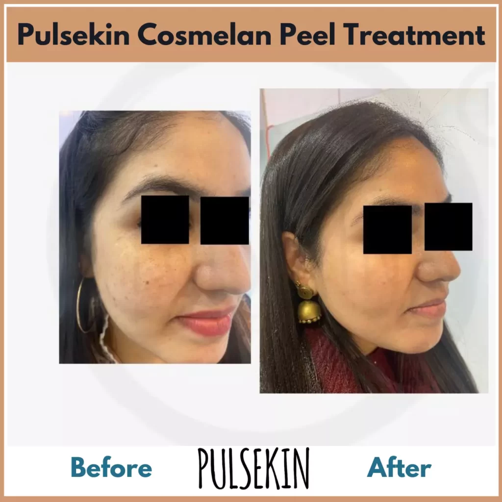 Pulsekin Cosmelan Peel Results